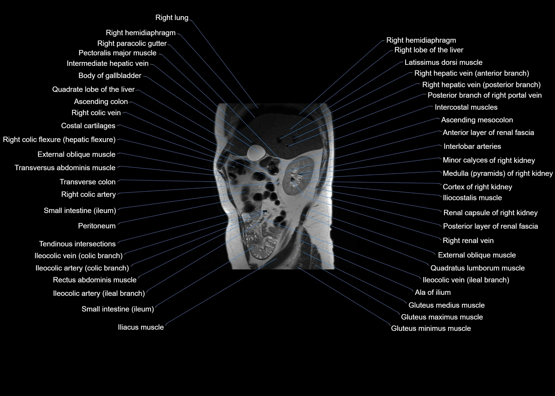 MRI abdomen sagittal cross sectional anatomy  radiology  image-img-00001-00022.webp